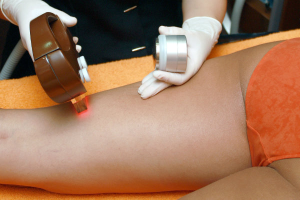 laser epilation definitive