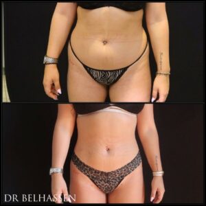 Effets de la liposuccion
