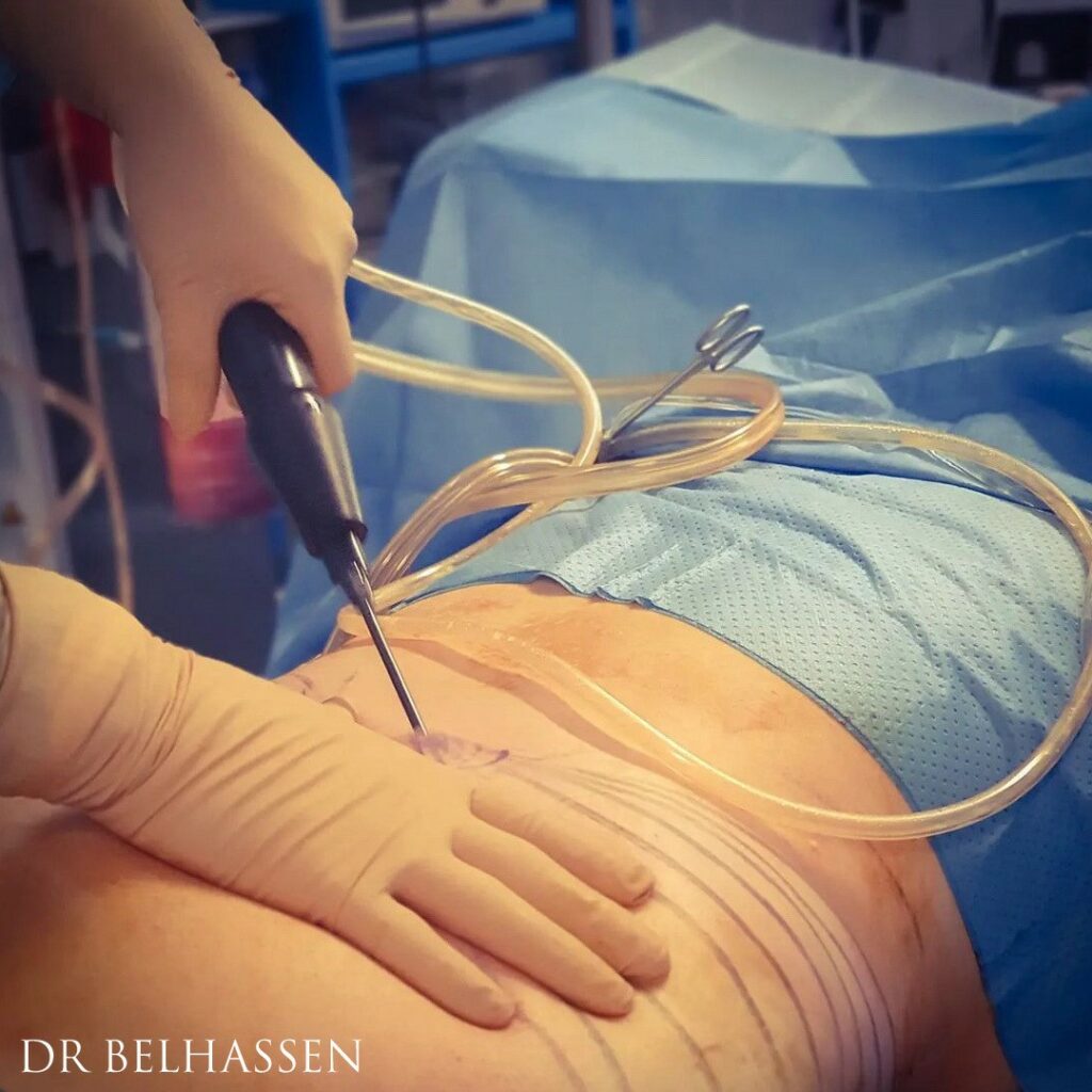 Une opération de liposuccion a été la solution à mon problème de poids