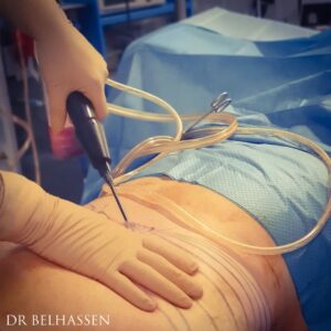Une opération de liposuccion